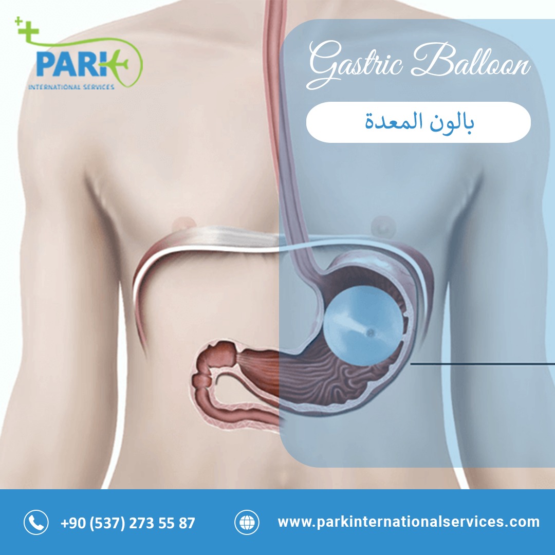 Gastric Balloon - Park International Services